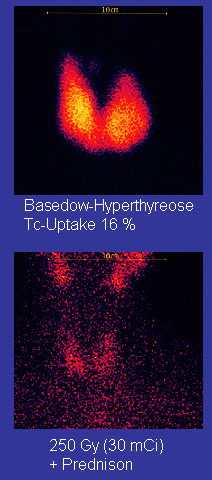 Upper image: two drop-like features merged at their bottoms; they have a yellow centre and a red rim on a black background. Caption: Graves' Disease Tc-Uptake 16%. Lower image: red dots on black background. Caption: 250 Gy (30mCi) + Prednison.