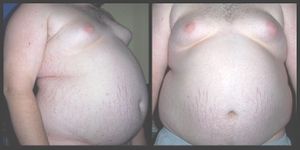 A front and side view of a morbidly obese male torso. Stretch marks of the skin are visible along with gynecomastia.