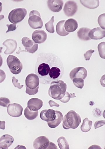 ملف:Hypogranular neutrophil with a pseudo-Pelger-Huet nucleus in MDS.jpg