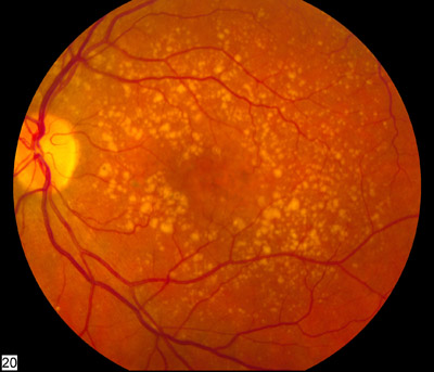 ملف:Intermediate age related macular degeneration.jpg
