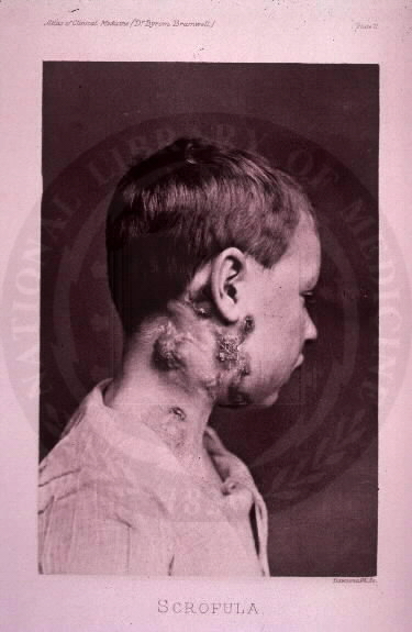 ملف:Scrofula.jpeg