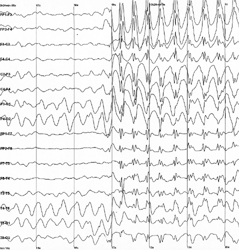 ملف:Spike-waves.png