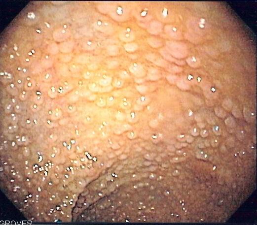 ملف:Familial adenomatous polyposis as seen on sigmoidoscopy.jpg