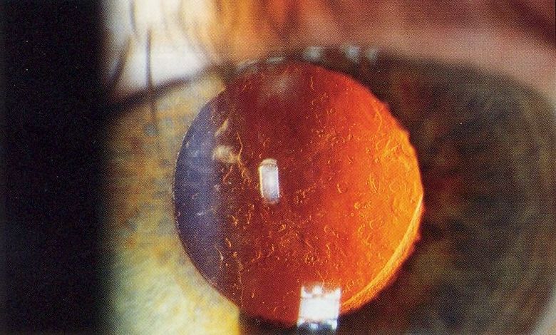 ملف:Posterior capsular opacification on retroillumination.jpg