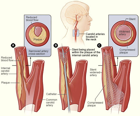 ملف:Cad stentplacement.jpg