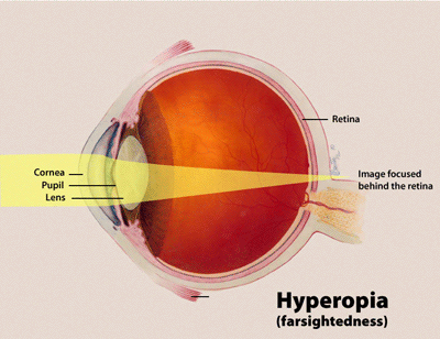 ملف:Hyperopia.gif