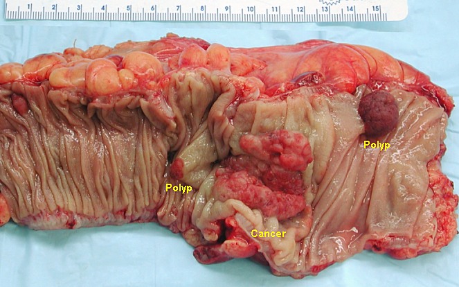 ملف:Colon cancer.jpg