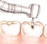 الحفر. يستخدم طبيب الأسنان مثقبًا لإزالة النخر والأجزاء الطرية من السن، وليشكل تجاويف وحواف تساعد على الإمساك بالحشوة.