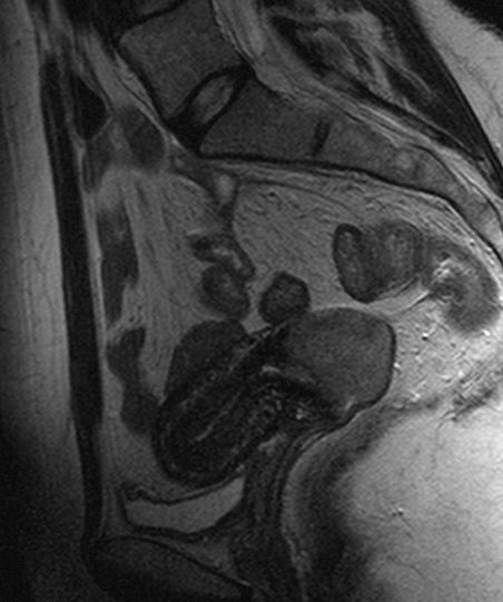 ملف:Ca cervicis uteri T2 SAG.jpg