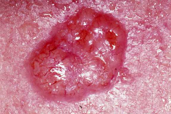 ملف:Basal cell carcinoma.jpg