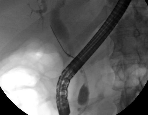 ملف:ERCP cholangioca.jpg