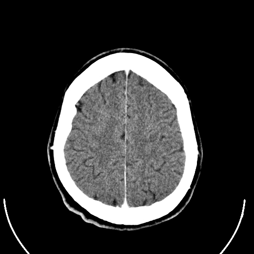 ملف:Computed tomography of brain of Mikael Häggström (25).png