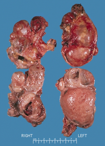 ملف:Bilateral pheo MEN2.jpg
