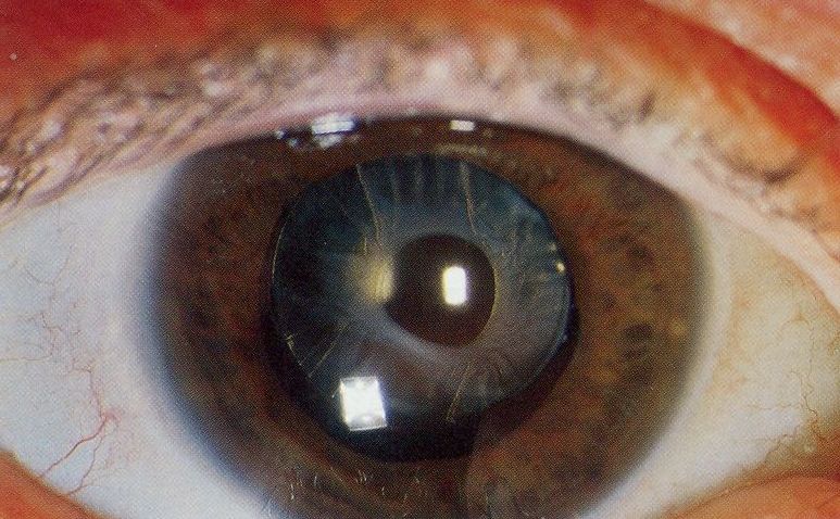 ملف:Anterior capsular opacification.jpg