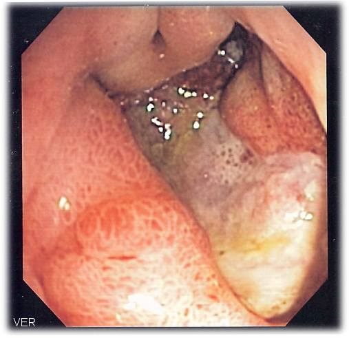 ملف:Deep gastric ulcer.png