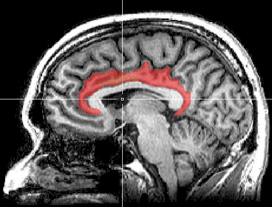 ملف:MRI cingulate cortex.png