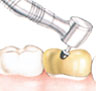 التهيئة الأخيرة. قد يستخدم طبيب الأسنان حجر سحن صغير لإجراء تعديلات طفيفة على التاج لكي يطابق السن بشكل جديد.