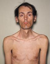 Myotonic dystrophy patient.JPG