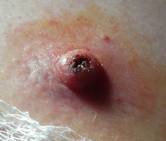 ملف:Keratoacanthoma 2.jpg