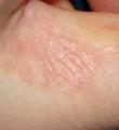 Acarodermatitis Finger.jpg