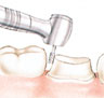 تحضير السن.يستخدم طبيب الأسنان المثقب لإزالة الأجزاء المصابة في السن ولتشكيل السن بحيث يمكن إطباق التاج فوقه.