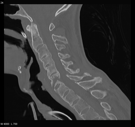 ملف:Ankylosing spondylitis.jpg