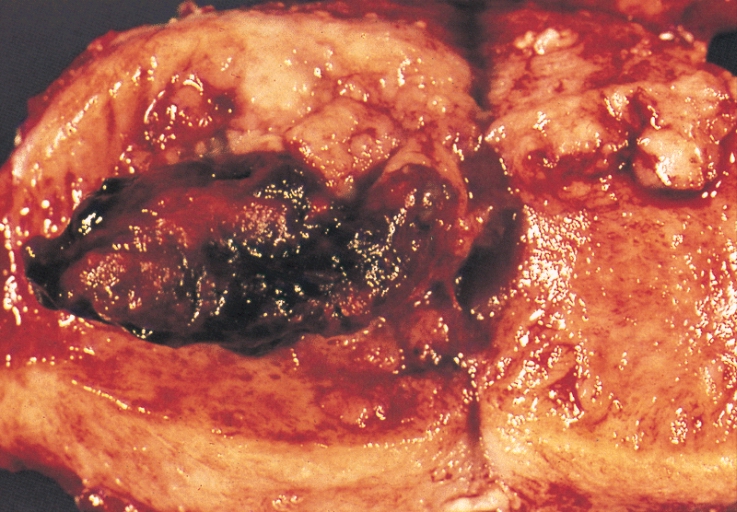 ملف:Endometrial adenocarcinoma gross.jpg