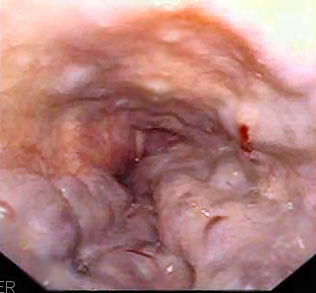 ملف:Esophageal varices - wale.jpg