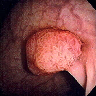 ملف:Polyp-2.jpeg