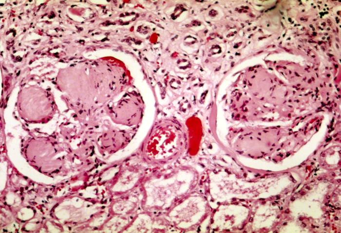 ملف:Nodular glomerulosclerosis.jpeg