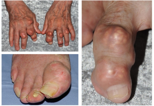 ملف:Tophaceous gout.jpg