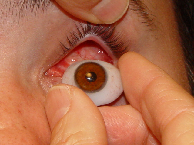 ملف:Colocación Protesis Ocular 4.jpg