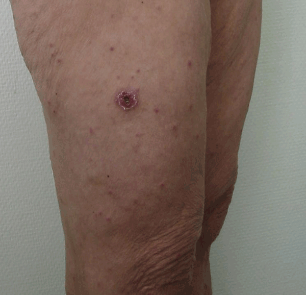 ملف:Eschar and spots Mediterranean spotted fever.gif
