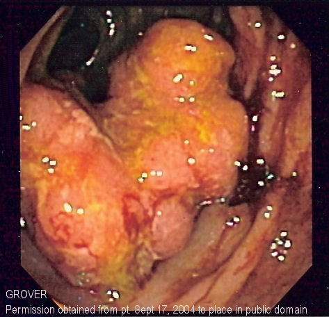 ملف:Colorectal cancer endo 2.jpg