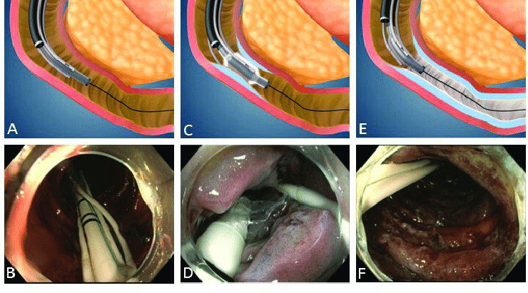 ملف:Duodenal mucosal resurfacing procedure.png