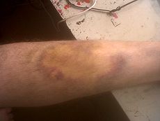 Ladder fall bruise.jpg