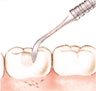 التسوية. يعدِّل طبيب الأسنان الحشوة بحذر لإعادة الشكل الأصلي للسن. وأخيرًا يجري تنعيم أي حواف خشنة.