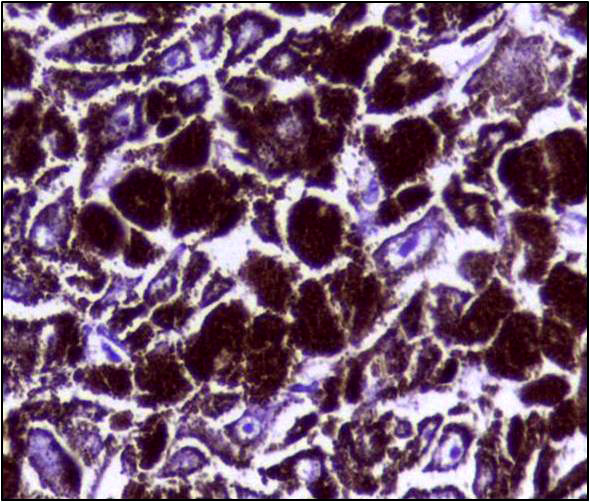 ملف:Histopathology of Malignant melanoma.jpg