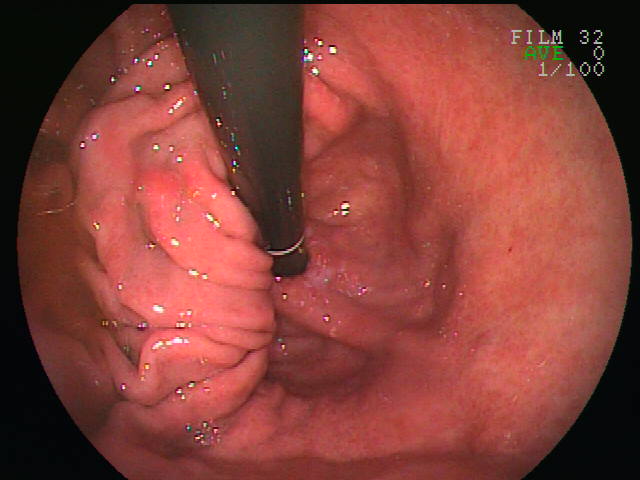 ملف:Sliding hernia(esophagus).jpg