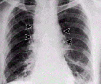 ملف:Anthrax - inhalational.jpg