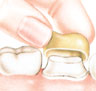 لصق التاج. يجب أن يطابق التاج السن التي تم إعدادها وكذلك المكان بالنسبة إلى الأسنان المجاورة لها وتلك الموجودة في الفك المقابل.