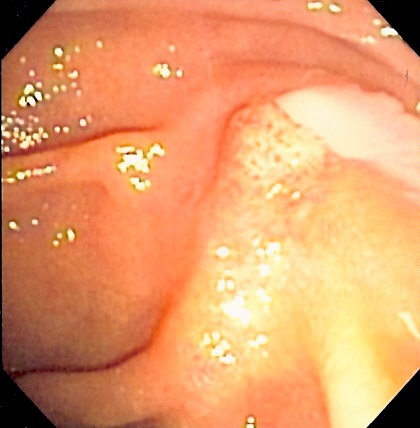 ملف:Cholangitis.jpg