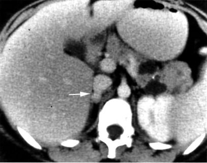 ملف:Pheochromocytoma2.jpg