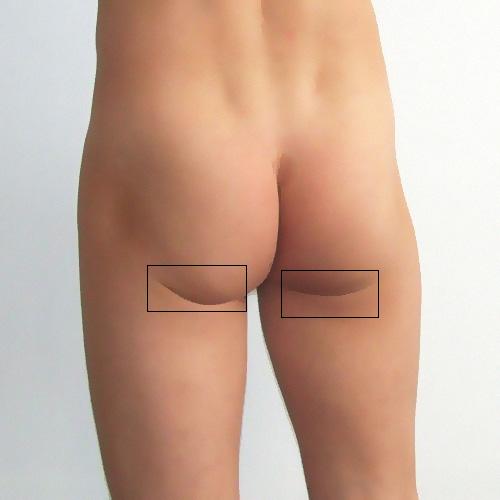 ملف:Horizontal gluteal crease2.jpg