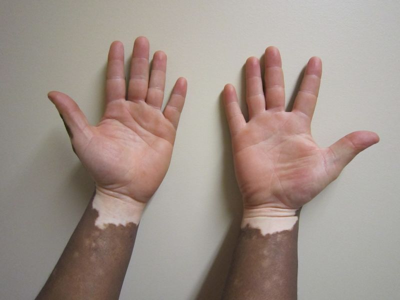 ملف:Vitiligo1.JPG
