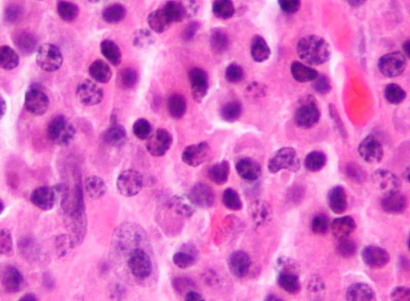 ملف:Plasmacytoma ultramini1.jpg