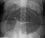 Plain X ray of a cecal volvulus