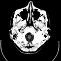 Computed tomography of brain of Mikael Häggström (1).png