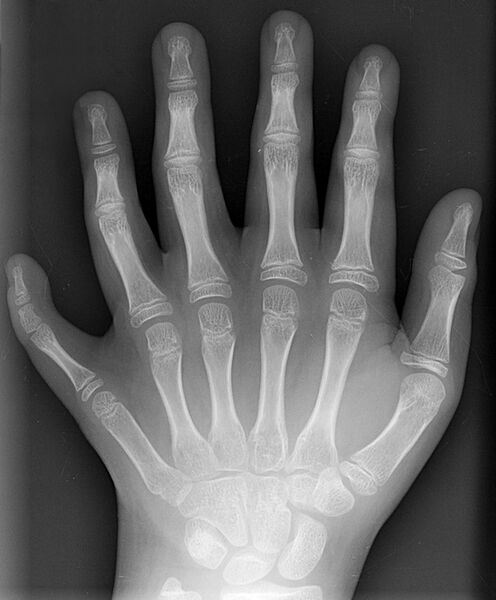 ملف:Polydactyly 01 Lhand AP.jpg