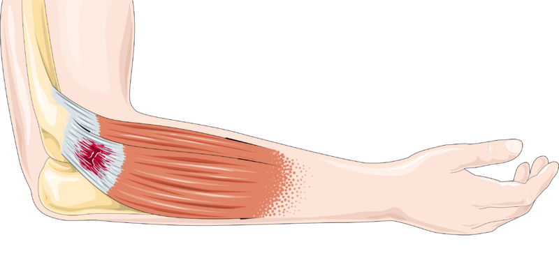 ملف:Tendon rupture -- Smart-Servier.png